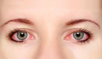 Oči alergika